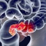 晚期结直肠癌新突破！赞扎替尼联合阿替利珠单抗获FDA受理，延长患者生存期