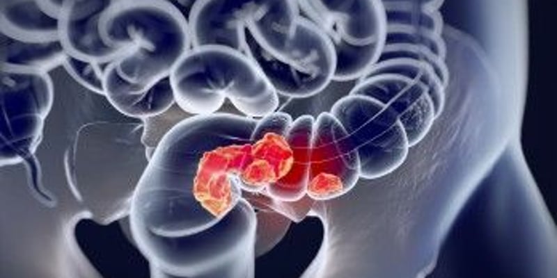 晚期结直肠癌新突破！赞扎替尼联合阿替利珠单抗获FDA受理，延长患者生存期