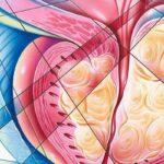 奥拉帕利联合阿比特龙：BRCA/ATM突变mCRPC患者生存期新突破