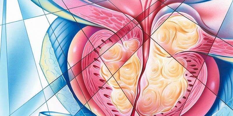 奥拉帕利联合阿比特龙：BRCA/ATM突变mCRPC患者生存期新突破