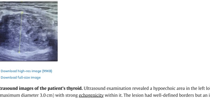 甲状腺癌 | 揭秘ALK重排与MEN1突变：克唑替尼靶向治疗，海外购药指南