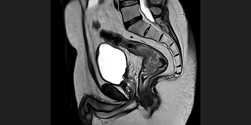 结直肠癌生存期预测新进展：’蛋白表观遗传评分’如何助力患者预后判断？