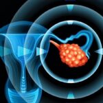 最新研究：生育次数少会增加卵巢癌风险？深度解析生殖因素与预防