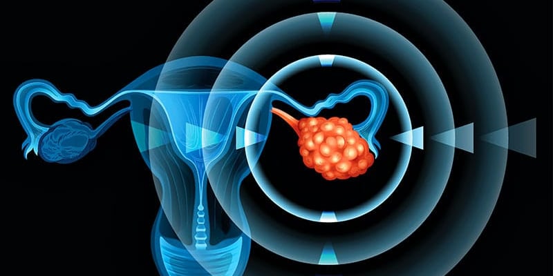 最新研究：生育次数少会增加卵巢癌风险？深度解析生殖因素与预防