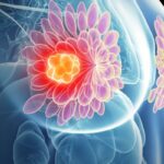 乳腺癌放疗新突破：5次治疗显奇效，局部晚期患者手术机会大增