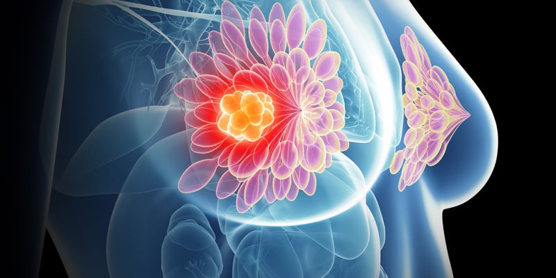 乳腺癌放疗新突破：5次治疗显奇效，局部晚期患者手术机会大增