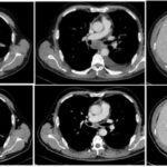 肺癌靶向药引发间质性肺炎怎么办？看这例“再挑战”成功案例，阿美替尼接力伏美替尼