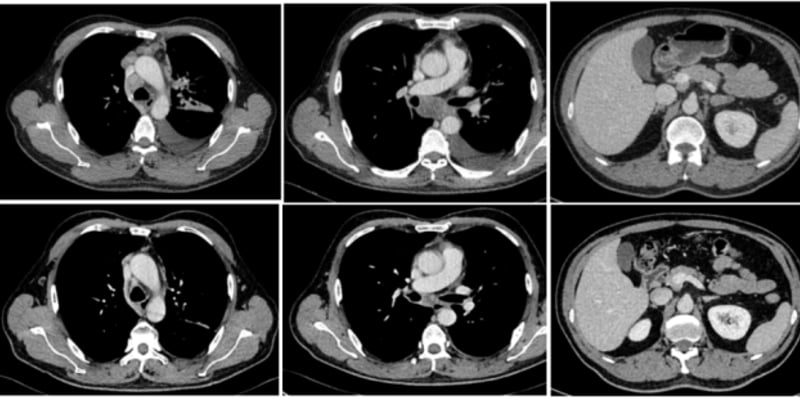 肺癌靶向药引发间质性肺炎怎么办？看这例“再挑战”成功案例，阿美替尼接力伏美替尼