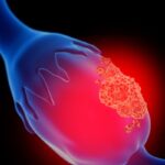 Relacorilant联合紫杉醇脂质体：铂耐药卵巢癌生存新希望，显著延长患者生命