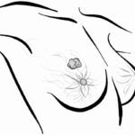 HER2低表达乳腺癌福音：德曲妥珠单抗真实世界安全性数据揭秘，副作用管理全指南