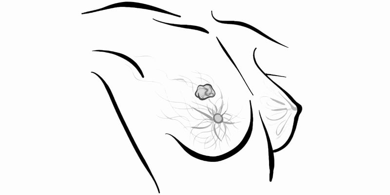 乳腺癌新药吉瑞斯群临床遇挫？深度解读persevERA数据背后的希望与挑战