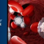 低危MDS合并高危特征：异基因造血干细胞移植(allo-HSCT)为何未改善总生存？关键数据与决策要点