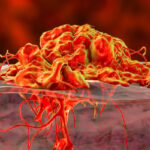 2026年罕见黑色素瘤治疗新突破：延长生存期的关键药物与疗法