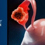 铂类耐药卵巢癌重大突破！FDA批准帕博利珠单抗方案，显著延长生存期