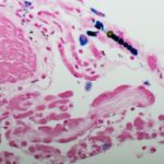 恶性胸膜间皮瘤重磅突破：双免疫疗法让五年生存率翻倍，晚期患者迎来长生存曙光