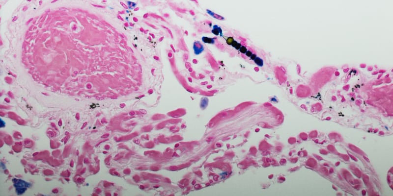 恶性胸膜间皮瘤重磅突破：双免疫疗法让五年生存率翻倍，晚期患者迎来长生存曙光