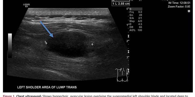 上皮样血管肉瘤合并SMARCB1突变怎么治？诊断分型、用药选择与进展监测