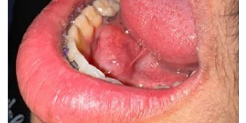 低级别纤维黏液样肉瘤怎么确诊与随访？口底肿块RNA测序和ctDNA监测要点