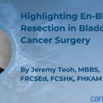 非肌层浸润性膀胱癌整块切除术：复发率如何降到更低