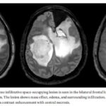 IDH1突变合并KIAA1549::BRAF融合：成人WHO4级星形细胞瘤如何做全面分子检测与用药选择