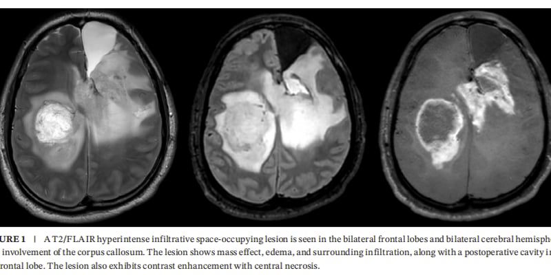 IDH1突变合并KIAA1549::BRAF融合：成人WHO4级星形细胞瘤如何做全面分子检测与用药选择