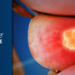 中危前列腺癌放疗联合瑞卢戈利：疗效与副作用全解