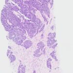 胸腺瘤复发后免疫治疗怎么选？TMB-H与阿替利珠单抗长期获益解析