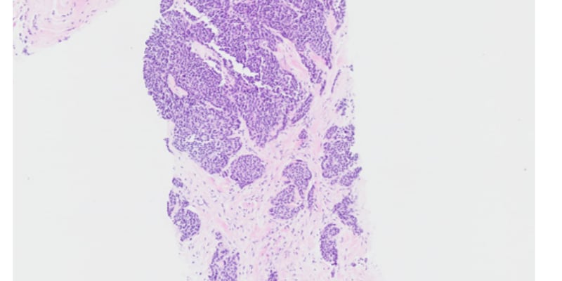 胸腺瘤复发后免疫治疗怎么选？TMB-H与阿替利珠单抗长期获益解析