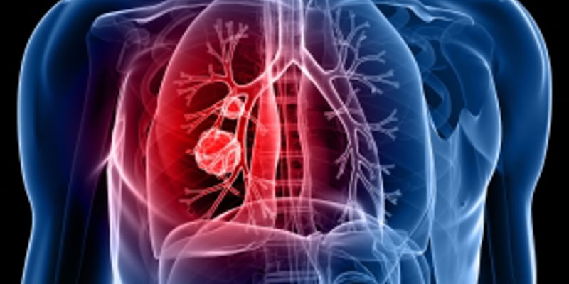 一线NSCLC新免疫联合方案为何叫停？读懂TACTI-004“无效分析”与下一步选择