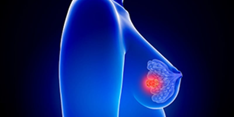 早期乳腺癌低分割放疗怎么选？3周与5周区域放疗疗效和副作用全解析