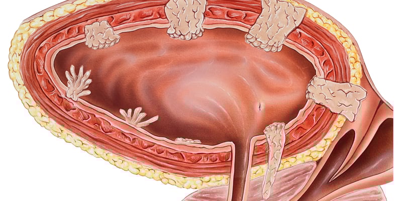 BCG非应答性非肌层浸润性膀胱癌怎么治？诺格白介素α联合BCG长期数据详解