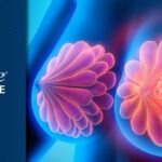 HER2阳性乳腺癌新进展：GLSI-100能否进一步降低复发？