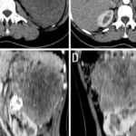 TFE3易位肾细胞癌怎么确诊？FISH阴性还要做RNA测序