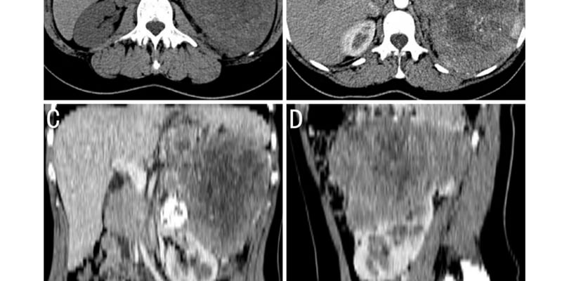 TFE3易位肾细胞癌怎么确诊？FISH阴性还要做RNA测序
