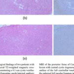 NF2相关神经鞘瘤怎么查？基因检测与治疗要点