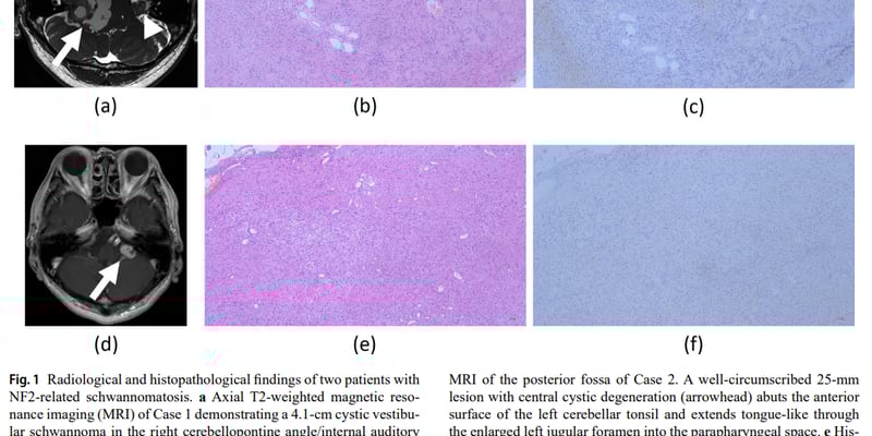 NF2相关神经鞘瘤怎么查？基因检测与治疗要点
