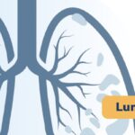 非小细胞肺癌一线免疫联合eftilagimod alfa为何叫停