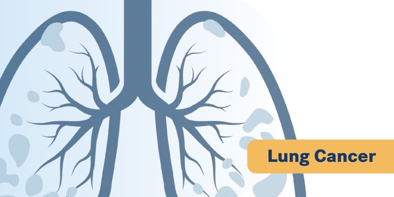 非小细胞肺癌一线免疫联合eftilagimod alfa为何叫停