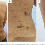 NF1合并高血压找不到原因？一文读懂WES如何揪出PKHD1与多囊肝线索