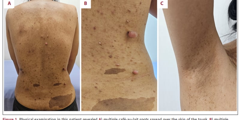 NF1合并高血压找不到原因？一文读懂WES如何揪出PKHD1与多囊肝线索