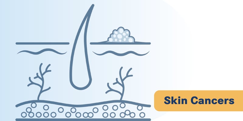 黑色素瘤要不要做前哨淋巴结活检？最新前瞻性研究给出更精准答案