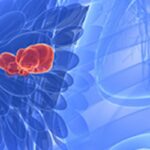 乳腺癌ctDNA检测有用吗？新辅助治疗后复发风险与预后判断全解