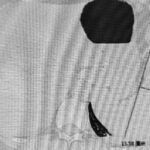 免疫治疗后持续高烧别硬扛：乳腺癌用特瑞普利单抗警惕HLH并学会自救