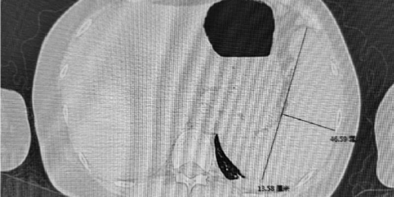 免疫治疗后持续高烧别硬扛：乳腺癌用特瑞普利单抗警惕HLH并学会自救