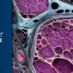 卡博替尼维持治疗高分级子宫肉瘤：疗效未增反增毒性怎么办