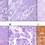 嗜酸性肾细胞癌伴MTOR突变怎么办？分子检测、转移风险与治疗选择
