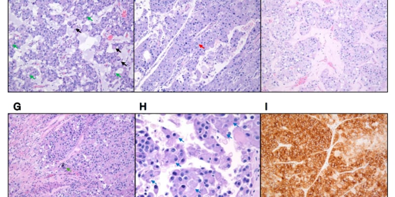 嗜酸性肾细胞癌伴MTOR突变怎么办？分子检测、转移风险与治疗选择