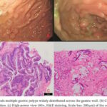 家族性腺瘤性息肉病筛查指南：年轻甲状腺癌与肠癌风险