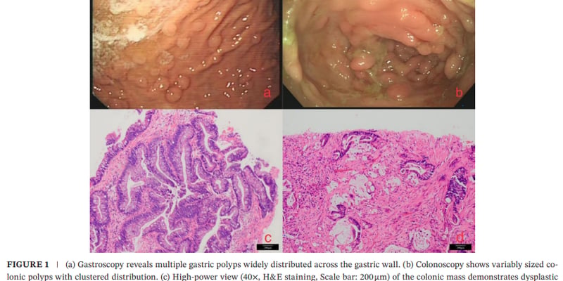 家族性腺瘤性息肉病筛查指南：年轻甲状腺癌与肠癌风险