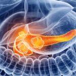 Daraxonrasib治疗转移性胰腺癌：生存获益与用药可及性解析